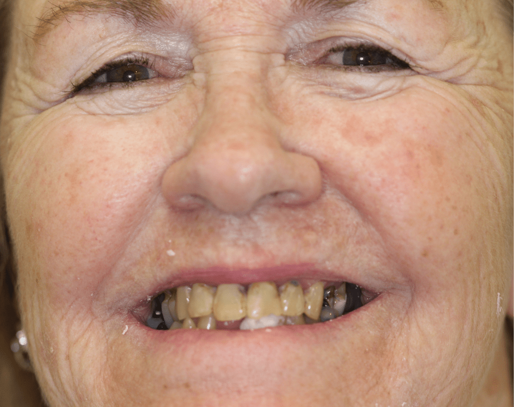 Berg-Debbie-Before