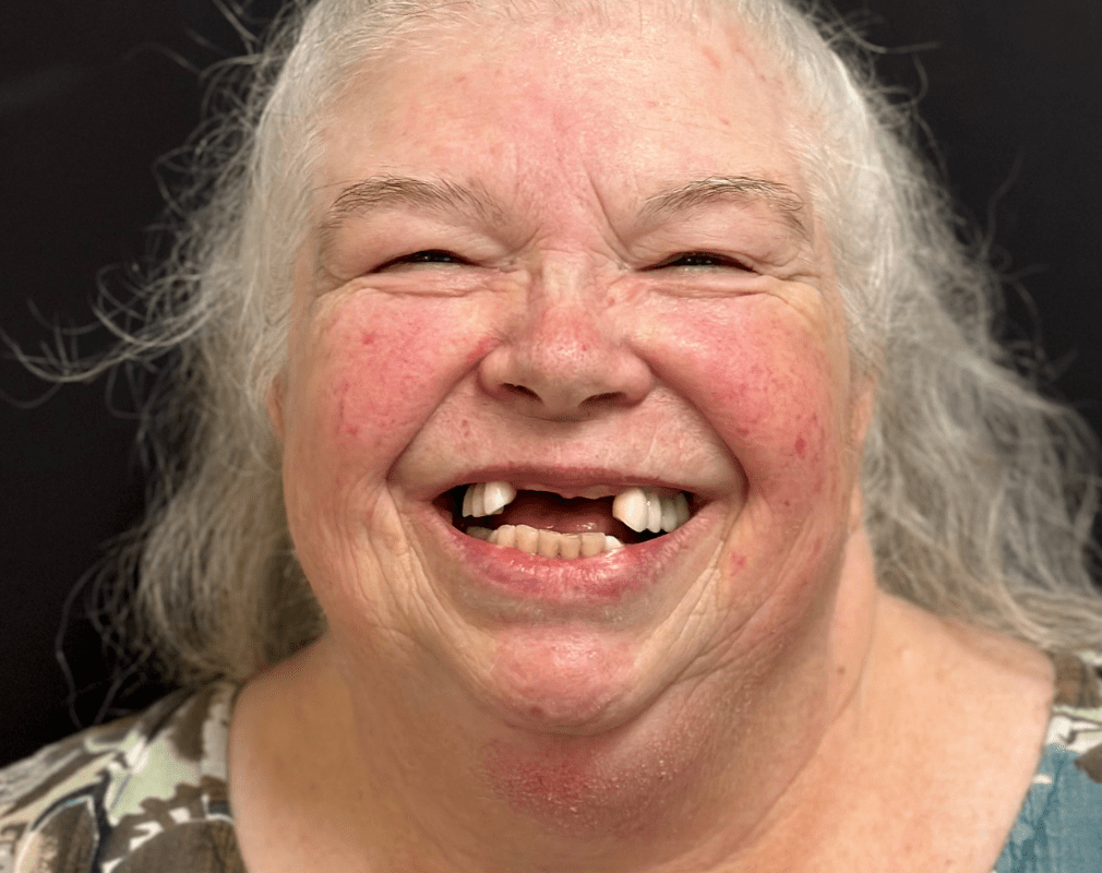 Smiling woman with missing teeth.